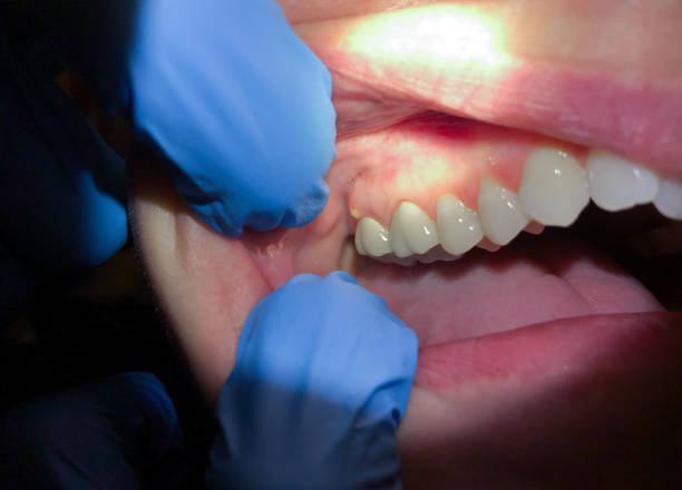 Best Emergency Dental Care for Broken or Chipped Teeth in White House, TN